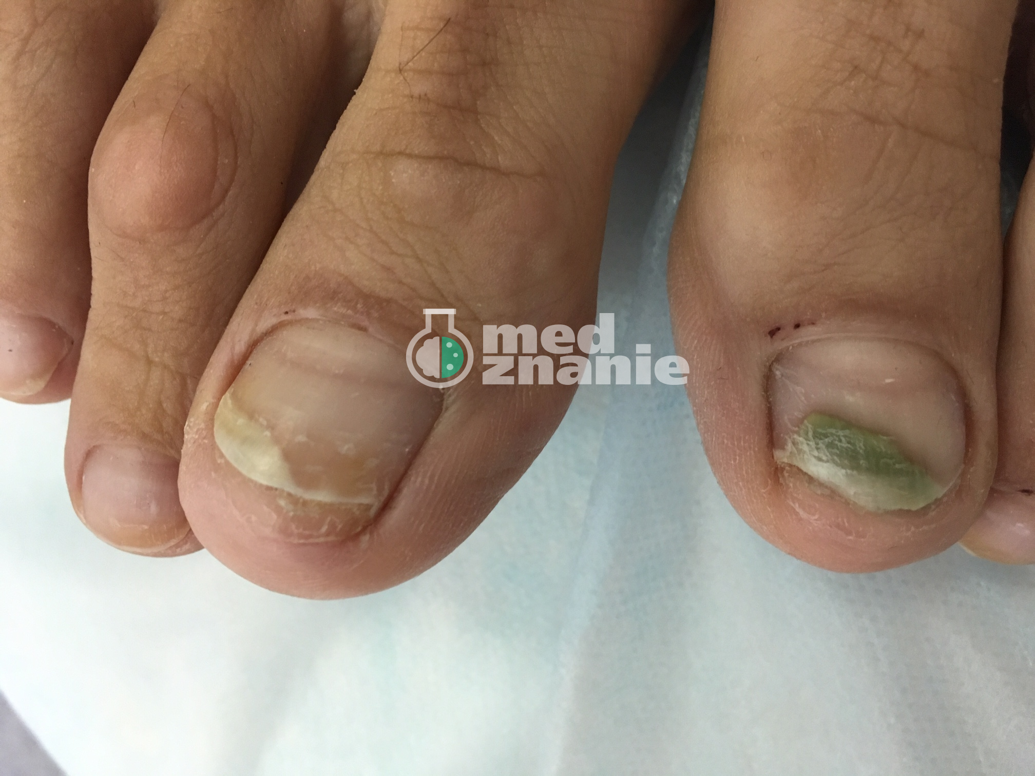 Ожог ногтей от гель-лака: признаки и лечение